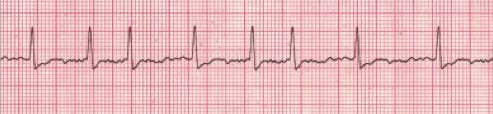 Stable And Unstable Tachycardia - NHCPS