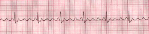 Stable And Unstable Tachycardia - NHCPS