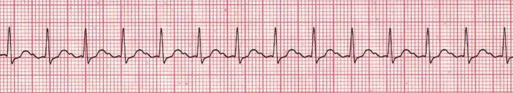 ACLS Stable and Unstable Tachycardia Guide