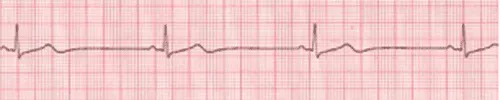 Sinus bradycardia graph