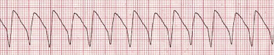Image result for Ventricular Tachycardia.