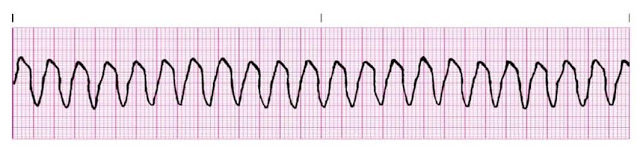 Polymorphic Ventricular Tachycardia