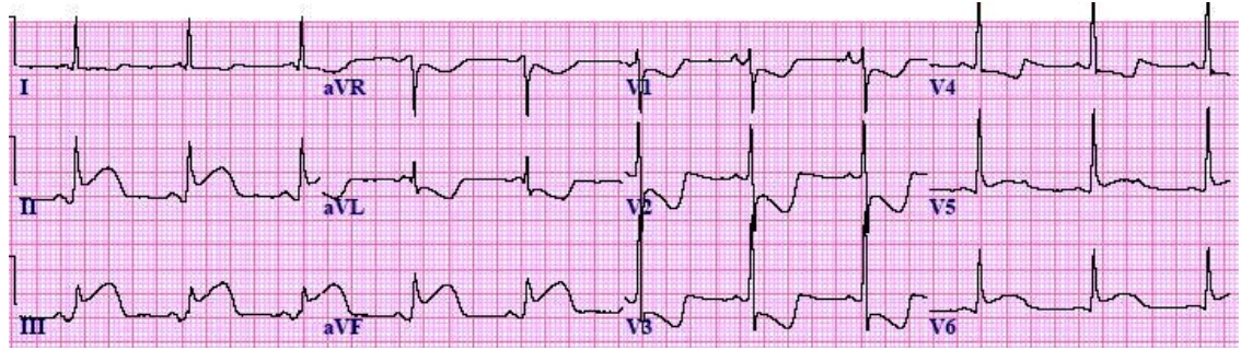 7 acute inferior stemi