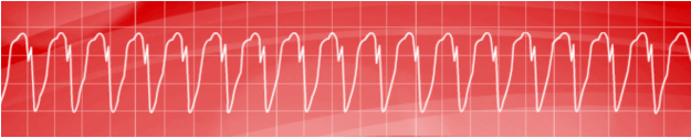 Monomorphic Ventricular Tachycardia