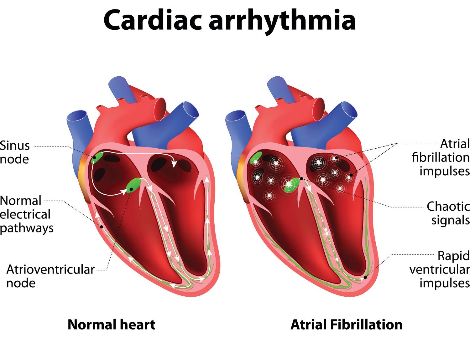 Illustration of cardiac arrhythmia comparing a normal heart to one with atrial fibrillation, showing chaotic electrical impulses.