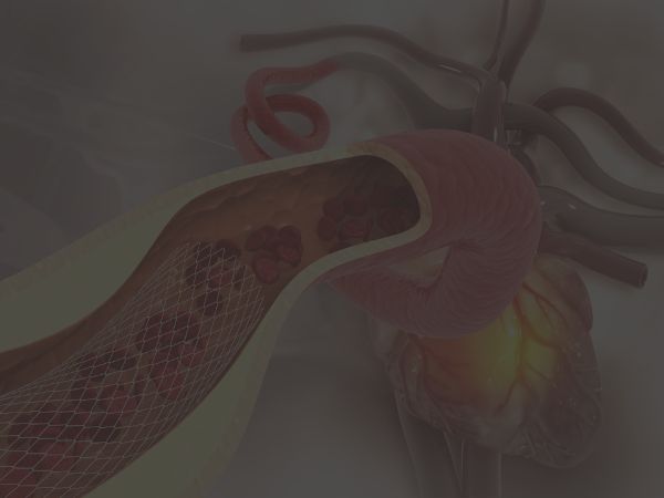 3D medical illustration showing a coronary artery with a stent, depicting a cardiac event related to hemodynamic instability.